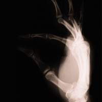thumb_xray_hand.JPG